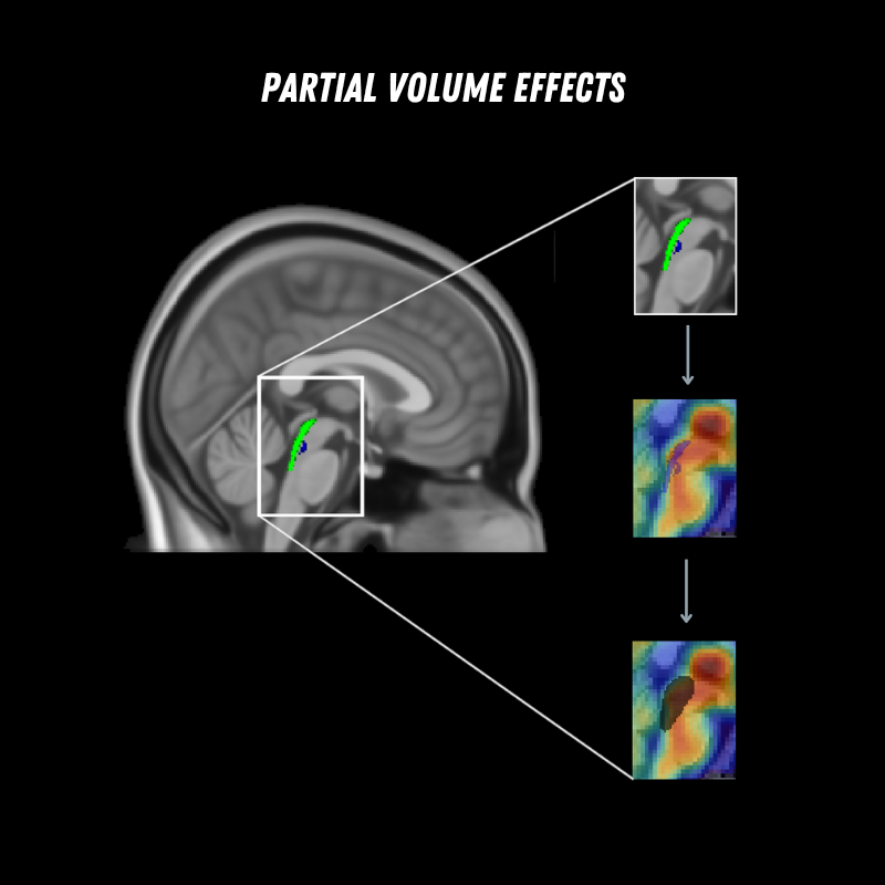 MRI and PET illustration showing partial volume effects in the midbrain
