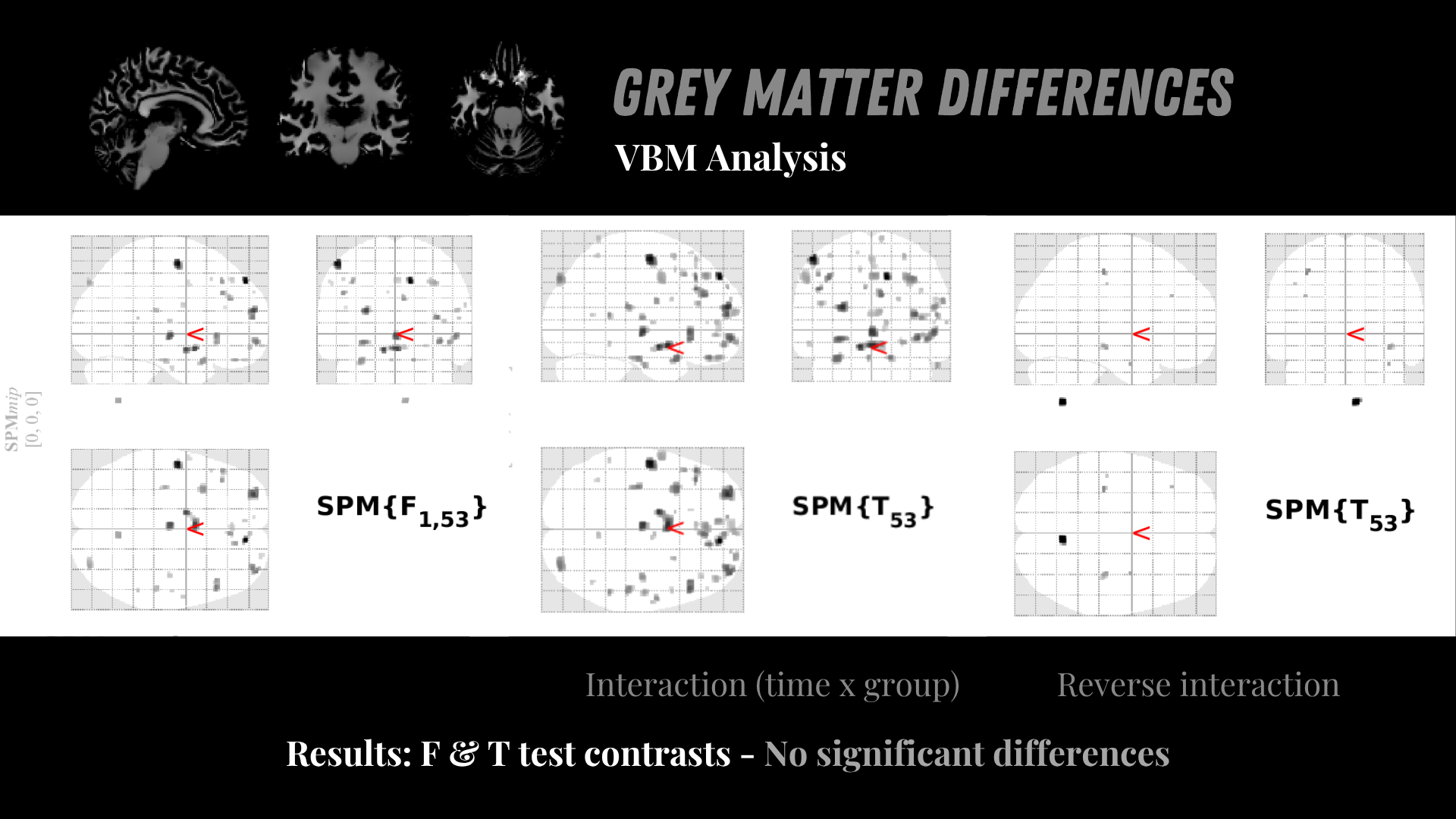 Volumetric-based Morphometry analysis results of gray matter volume differences across groups and cycle phases